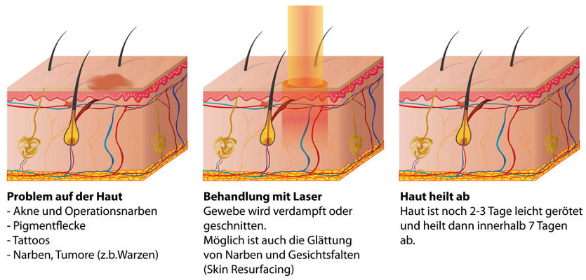 Aknenarben lasern - schematische Darstellung