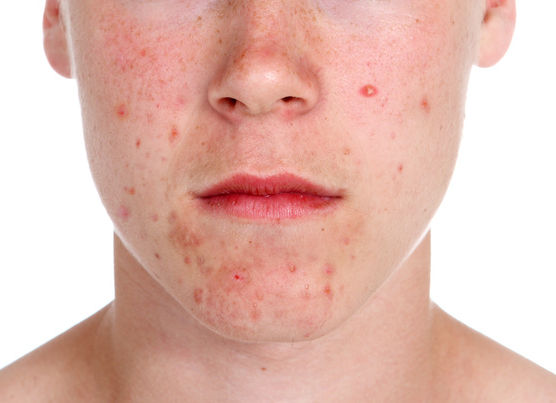 Aktive Akne im Gesicht eines Jugendlichen