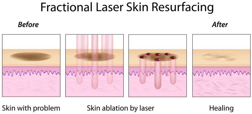 Fractional Laser Skin Resurfacing Schema