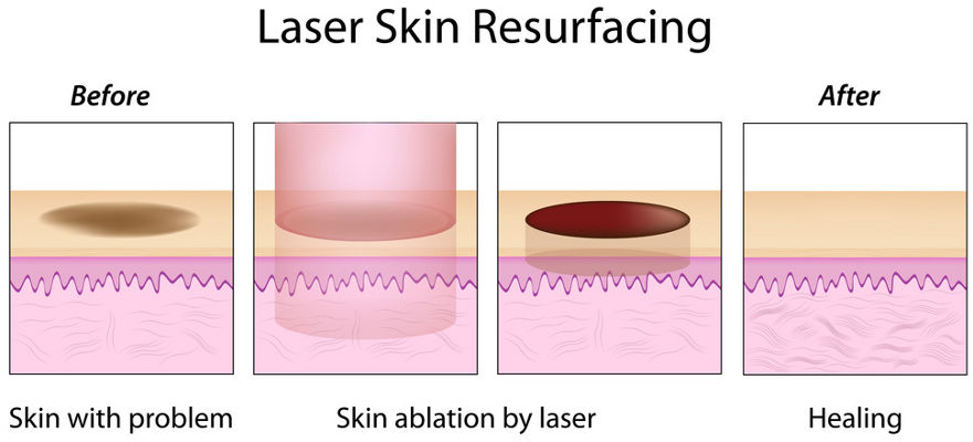 Laser Skin Resurfacing Schema